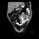 Burkitt's lymphoma of small bowel and liver: CT - Computed tomography